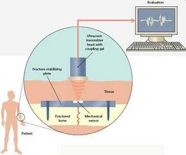 Ultrasound Sebagai Pengobatan Tulang Retak