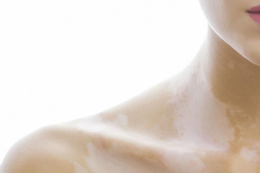 Panu, Penyebab dan Solusinya