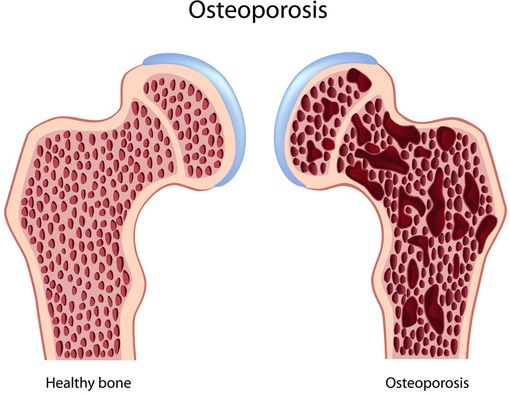 Wanita, Cegah Osteoporosis dengan Olahraga Ini