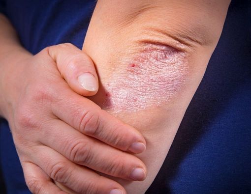 Manfaat Terapi Biologis untuk Penanganan Psoriasis