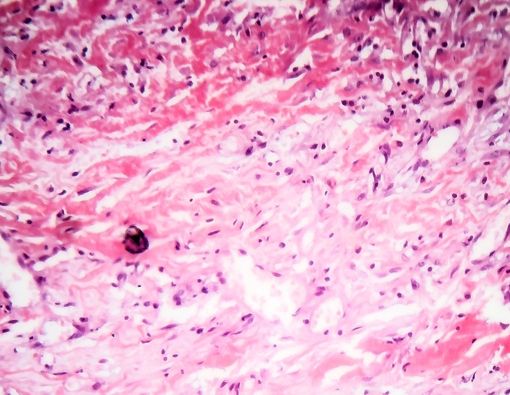 Rekomendasi Makanan untuk Penderita Pleuritis