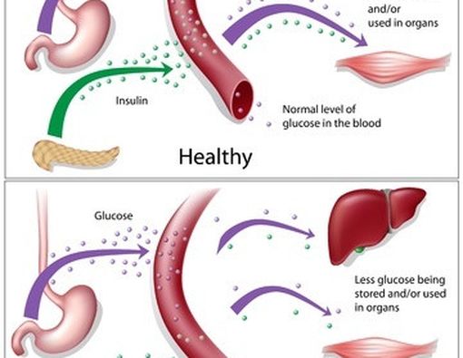 Bisakah Diabetes Melitus Tipe 1 Disembuhkan?