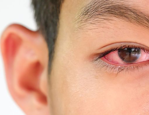 Mata Merah Tanda Gejala Positif Corona, Hoaks atau Fakta?