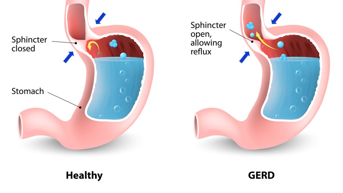 Pedoman Hidup Sehat untuk Penderita GERD
