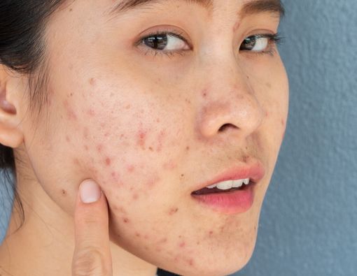 Jerawat Mendem di Muka, Kenali Penyebab dan Cara Jitu Menghilangkannya