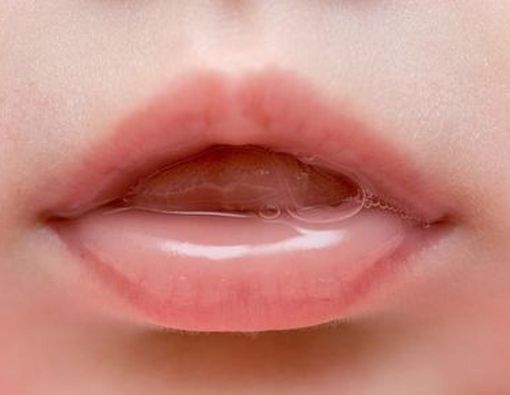 Kenali Penyebab Mulut Kering