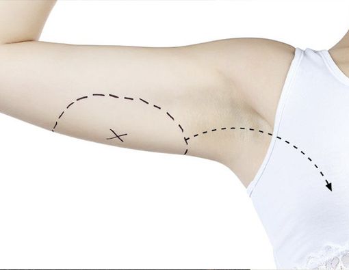 Langsing dengan Metode Transfer Lemak