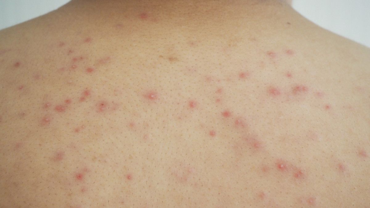 Tips Mengatasi Biang Keringat Saat Ibadah Haji