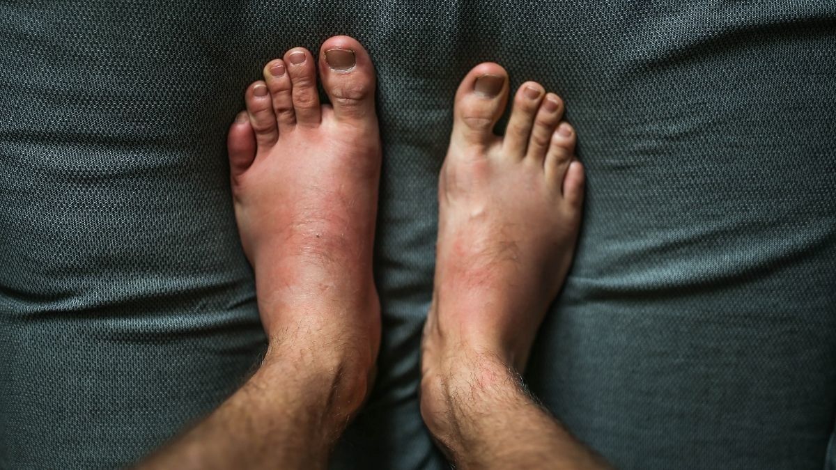 Jempol Kaki Anda Bengkak? Hati-Hati Gout