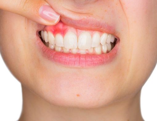 Serba-serbi Radang Gusi yang Perlu Anda Tahu