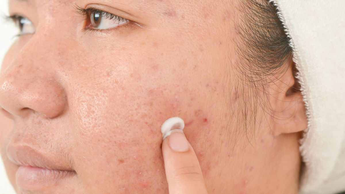 Cara Menggunakan Salicylic Acid pada Kulit Wajah