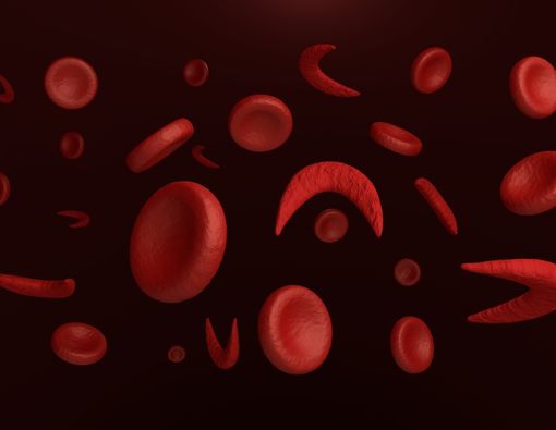 Mengenal Anemia Sel Sabit Lebih Dekat