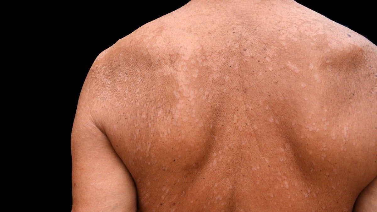 Mencegah dan Mengatasi Panu dengan Pola Makan Tepat