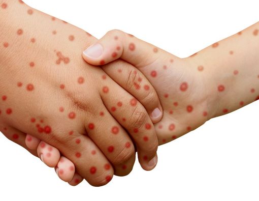 Penyebab Penyakit Campak dan Penularannya