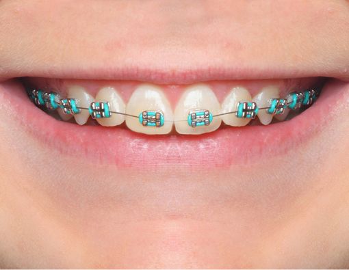 Masalah Kesehatan Gigi yang Mengintai Pengguna Behel