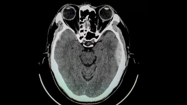 Kenali Kondisi Cedera Kepala Epidural Hematoma