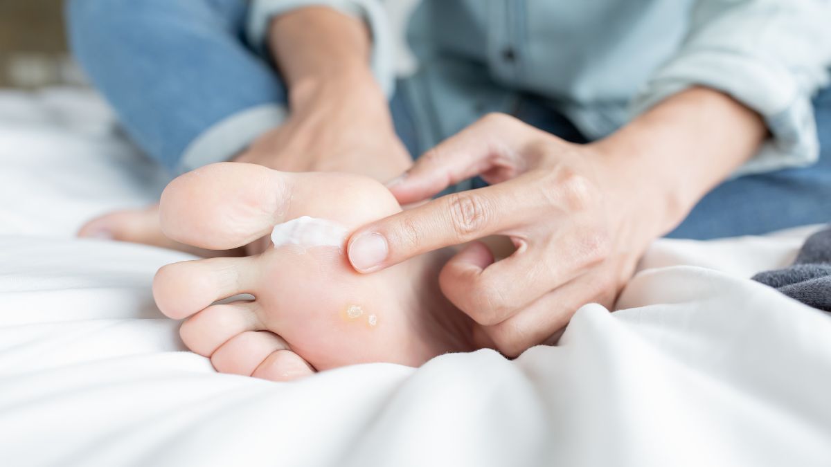 Catat, 7 Cara Menghilangkan Kutu Air Paling Ampuh