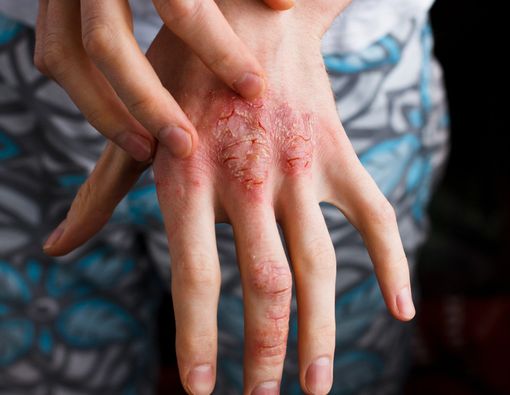 Dermatitis Atopik (Eksim Atopik)
