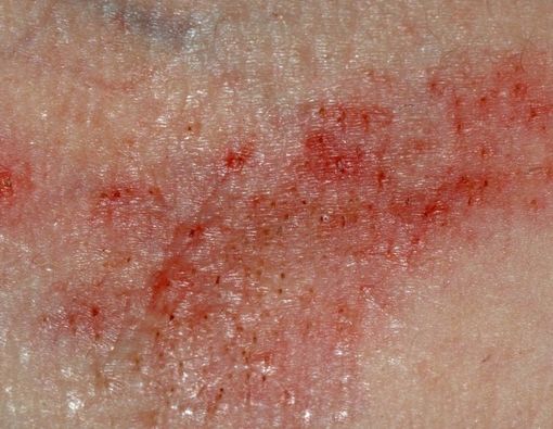 Muncul Ruam saat Demam? Waspada Sindrom Sweet!