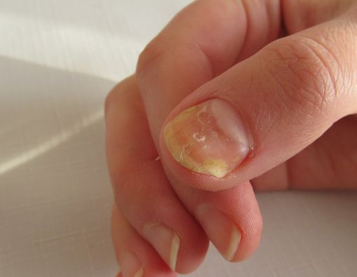 Kuku Berwarna Kuning, Apa Penyebabnya?