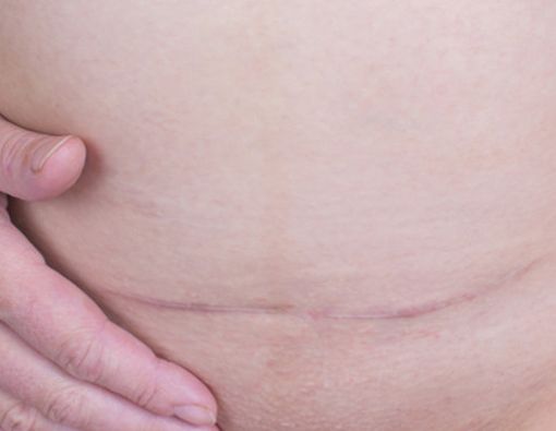 Tips Merawat Luka Operasi Caesar seperti Nikita Mirzani