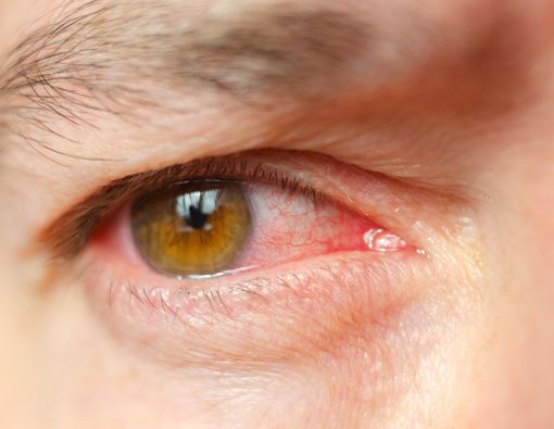 Muncul Urat Merah di Mata? Ini Penyebab dan Cara Mengatasinya