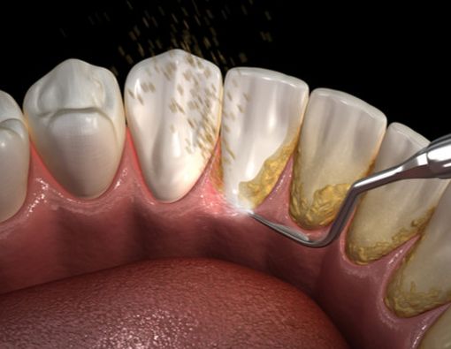Mengapa Terasa Ngilu Saat Karang Gigi Dibersihkan?