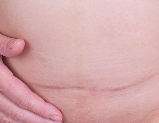 Tanda-Tanda Infeksi Luka Operasi Caesar yang Harus Diwaspadai