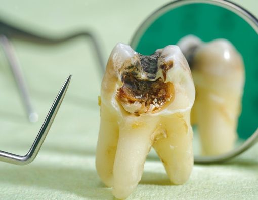 Mengidentifikasi Gigi Mati dan Pilihan Perawatannya