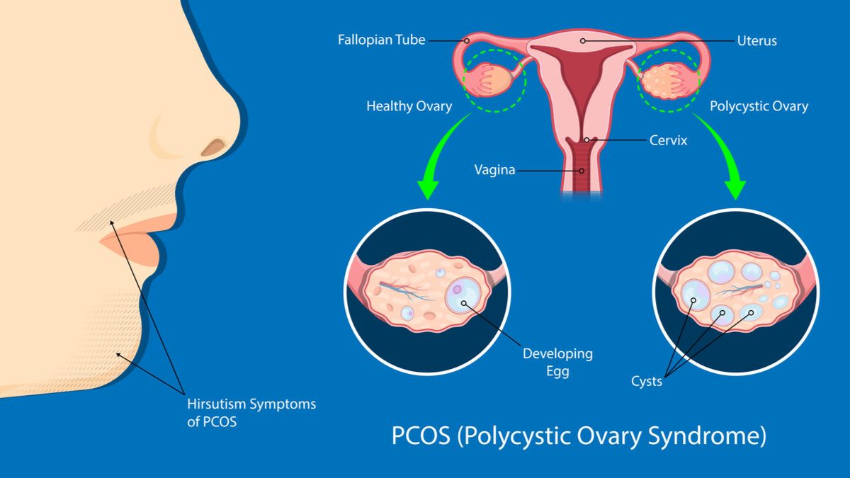 Penyebab Perimenopause Ovary Pain yang Mesti Diwaspadai KlikDokter