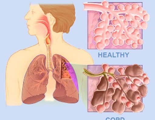 Awas Penyakit Paru Obstruktif Kronik