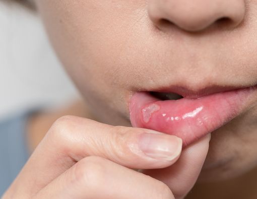 Ini Dia 9 Bahan Alami yang Dapat Menyembuhkan Sariawan