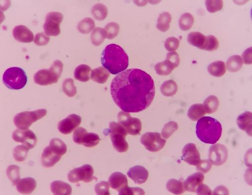 Gejala Trombositopenia yang Mesti Anda Waspadai