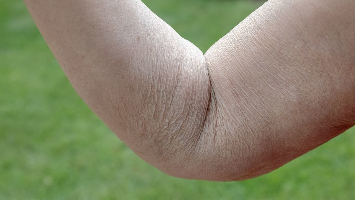 Mengenal Elastoderma, Penyakit Genetik Bikin Kulit Kendur