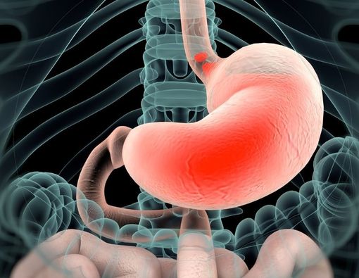 Waspada, GERD Sering Kambuh Tingkatkan Risiko Barrett's Esophagus