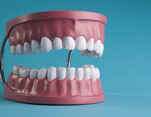 4 Faktor Risiko Terjadinya Microdontia atau Gigi Kecil