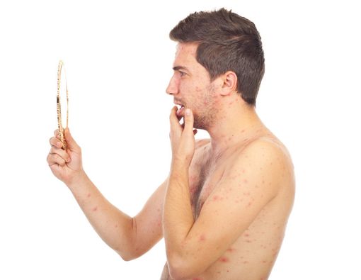 Apakah Semua Orang Pasti Akan Kena Cacar Air?