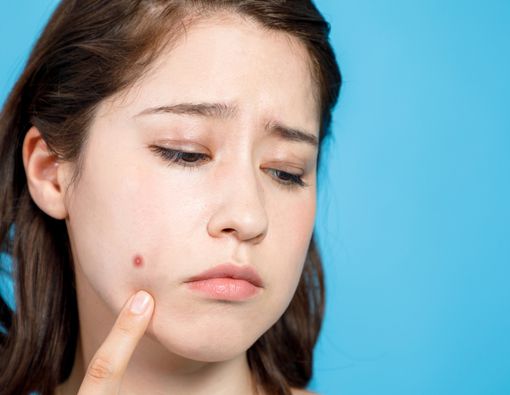 Ada Cacing Dalam Jerawat, Bagaimana Bisa?