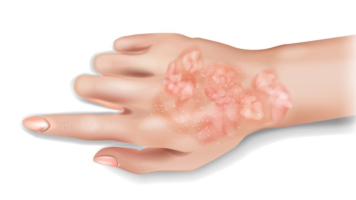 9 Tips Mencegah Psoriasis Kambuh