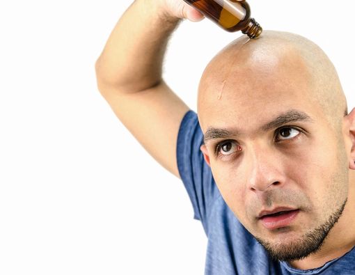 5 Pilihan Terapi untuk Atasi Kebotakan pada Pria