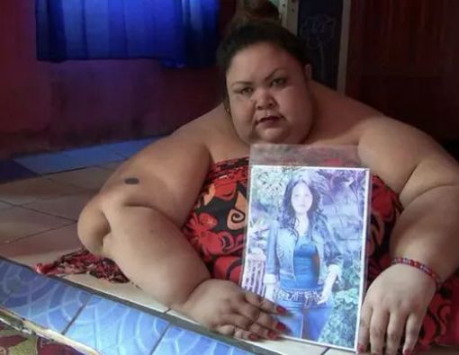 6 Penyakit Akibat Obesitas Rawan Dialami Wanita 350 kg di Kalteng