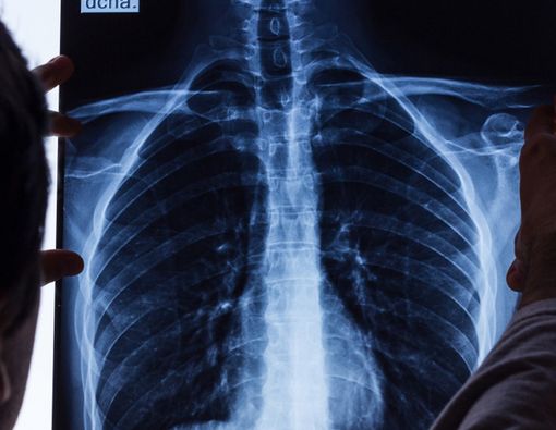 Pernah Patah Tulang Rusuk, Amankah Berolahraga Lagi?