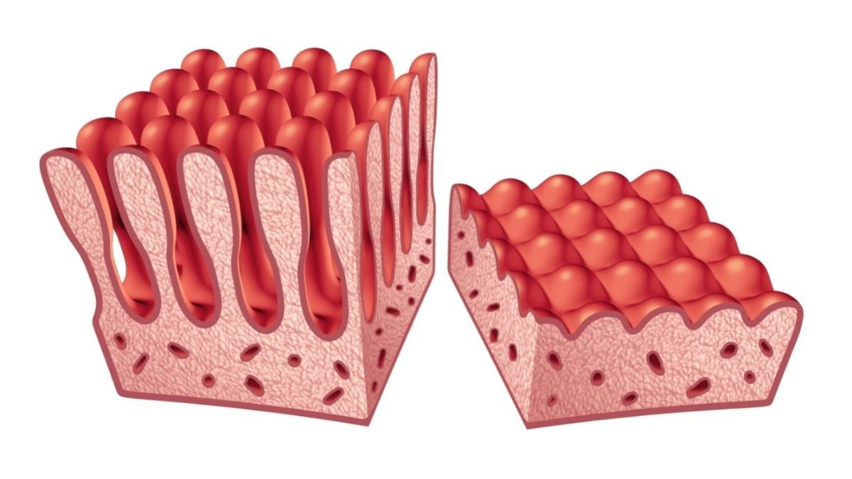 Sederet Bahaya Penyakit Celiac Terhadap Kesehatan Anak