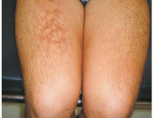 Biasa Taruh Laptop di Paha? Awas Kulit Bisa Rusak!