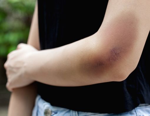 5 Hal yang Bikin Tubuh Gampang Memar