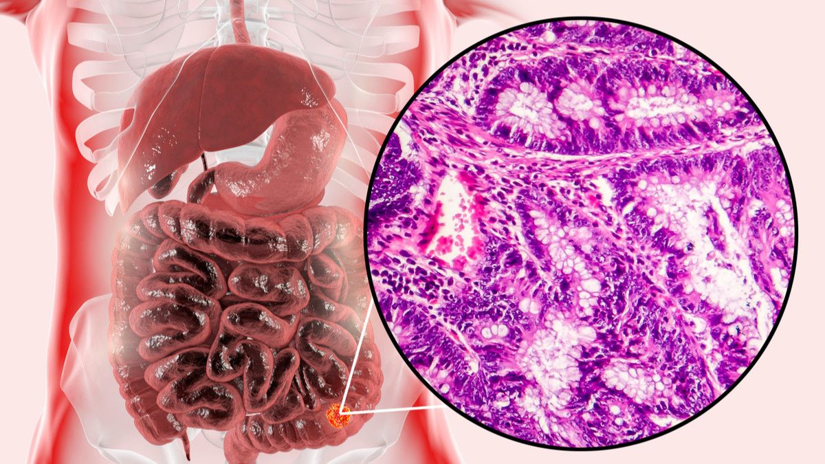 Mengapa Kanker Usus Bisa Sebabkan Badan Kurus?