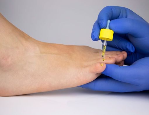 8 Obat Kurap Medis, Krim hingga Obat Minum