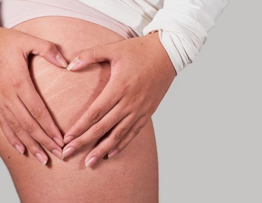 8 Penyebab Stretch Mark di Kulit