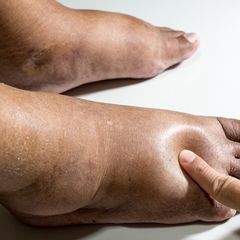 11 Penyebab Kaki Bengkak dan Cara Mengatasinya