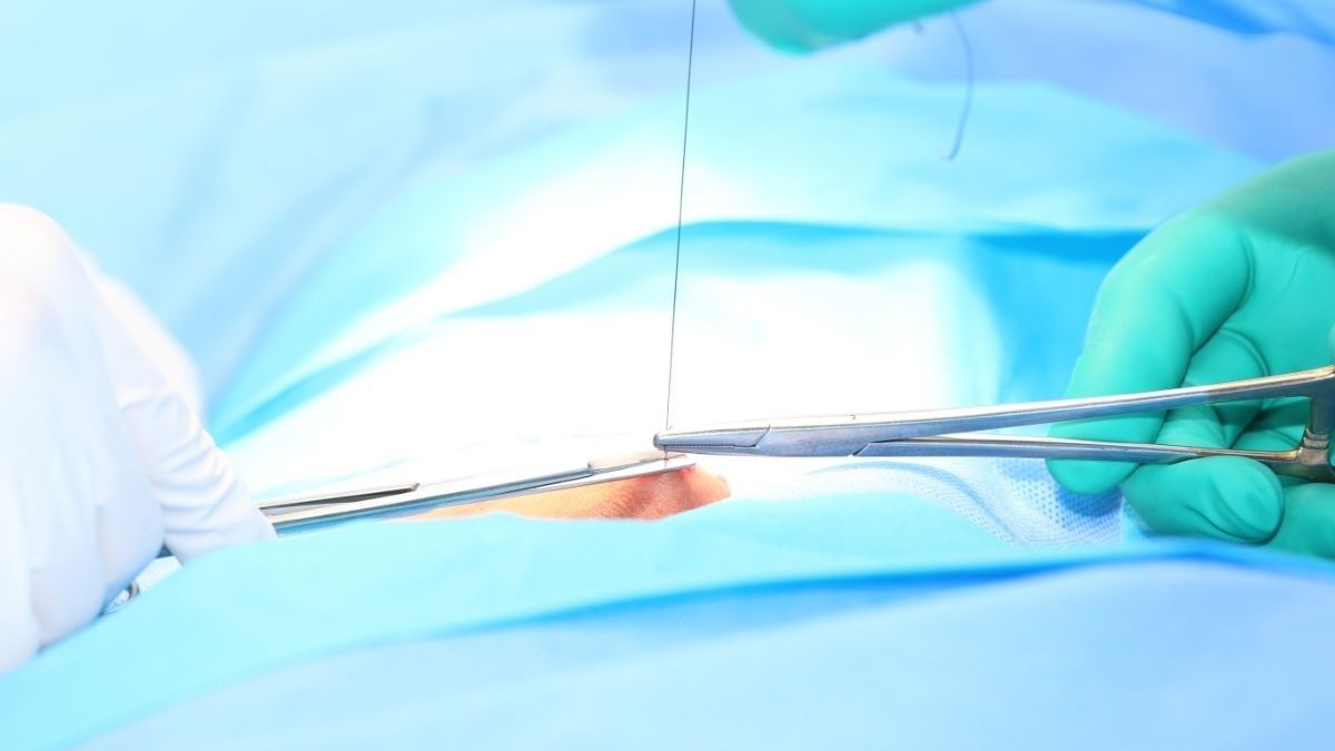 Cara Merawat Luka Jahitan di Vagina agar Cepat Kering